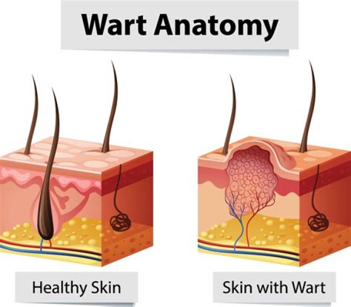 Can you cut off a wart?