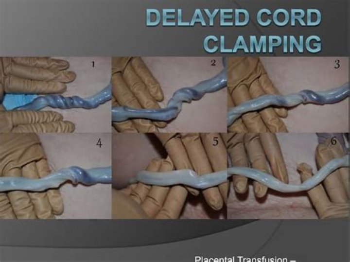 Can you delay cord clamping with a C section?
