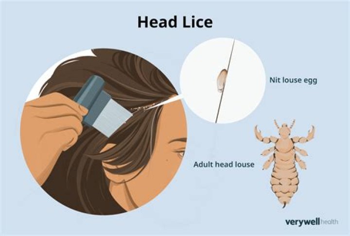 Can you feel lice biting your head?