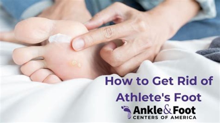 Can you get rid of athlete's foot forever?