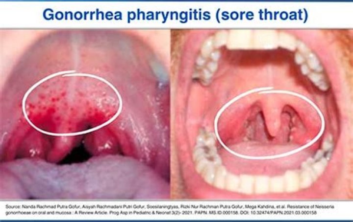 Can you get STD in throat?