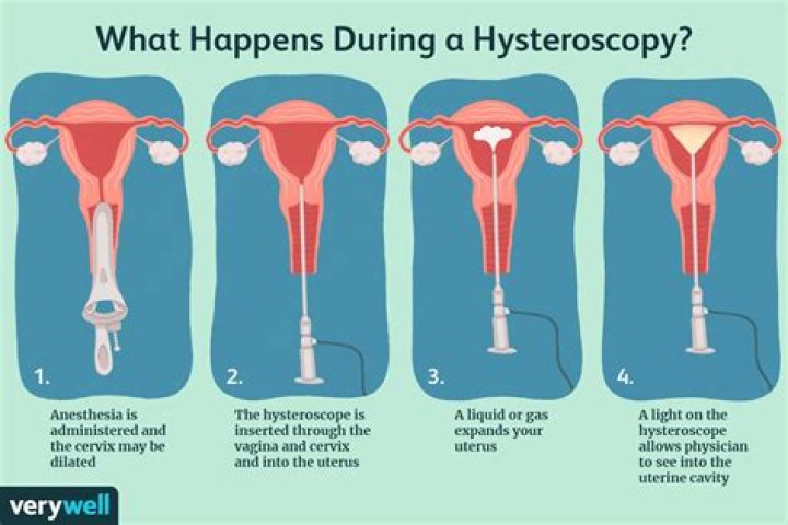 Can you have a colposcopy after a hysterectomy?
