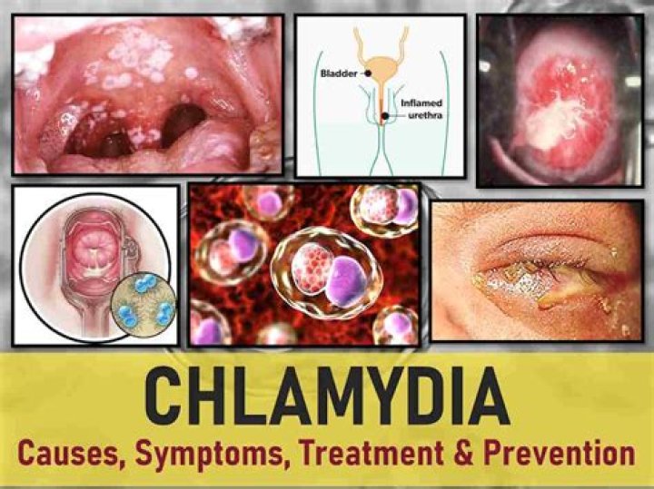 Can you have chlamydia for 5 years without knowing?