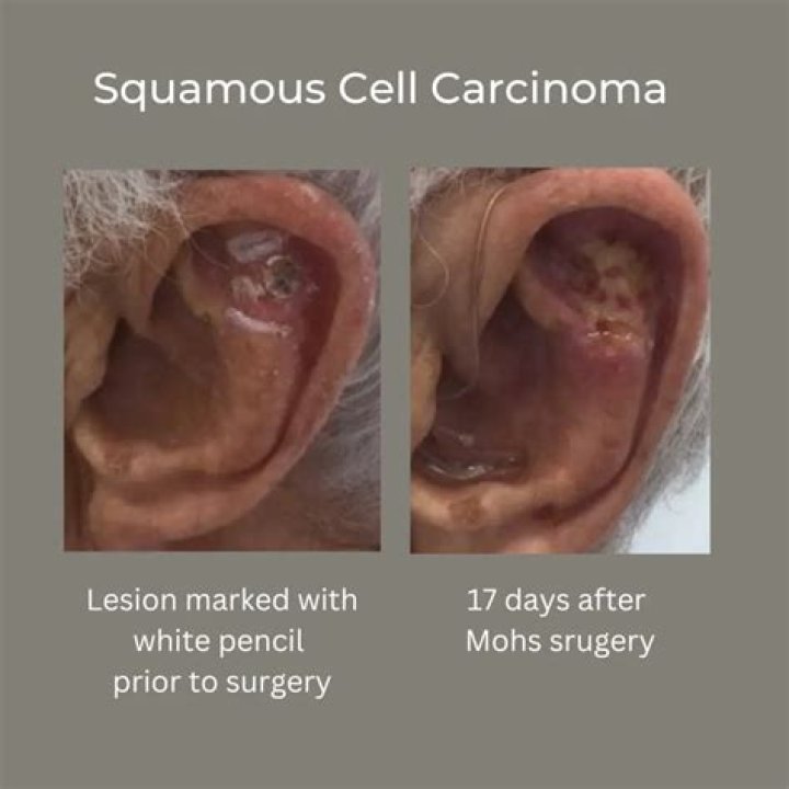 Can you have squamous cell carcinoma for years?