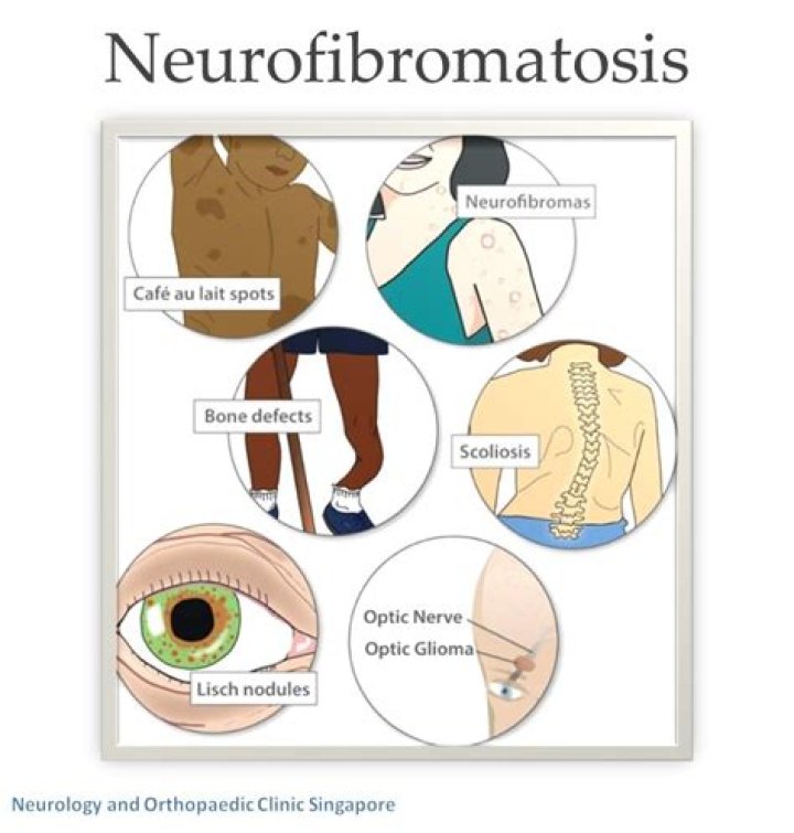 Can you prevent neurofibromatosis?