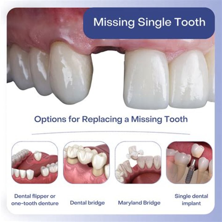 Can you replace one tooth?
