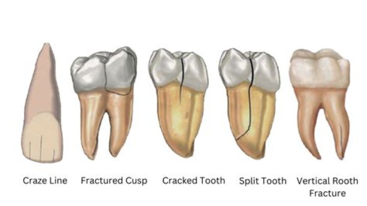 Can you seal a cracked tooth?