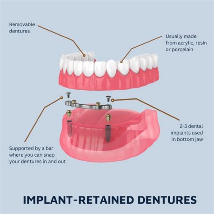 Can you sleep with denture implants?