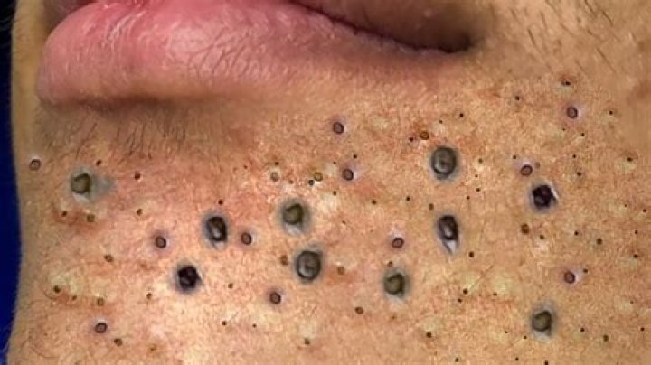 Can you wax blackheads out?