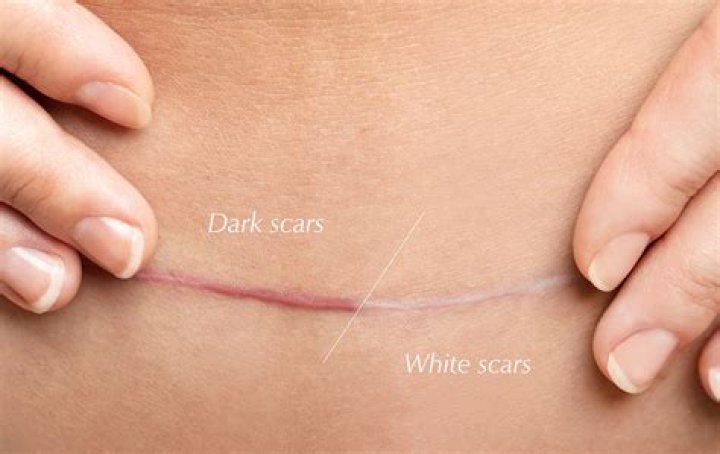 Do all scars turn white?