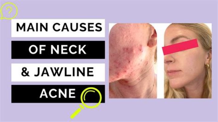 Do athletes have acne?