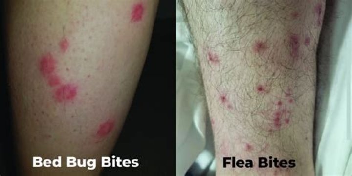 Do bedbugs bite legs?