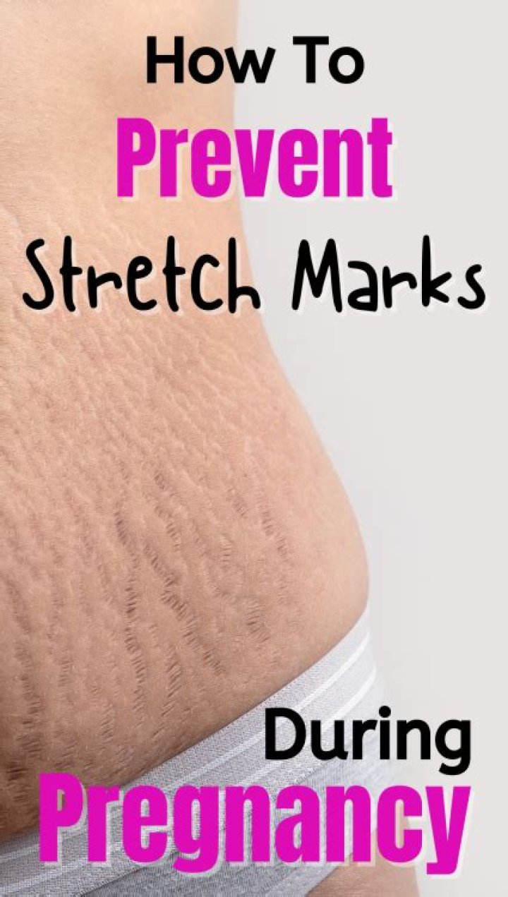Do belly bands prevent stretch marks?