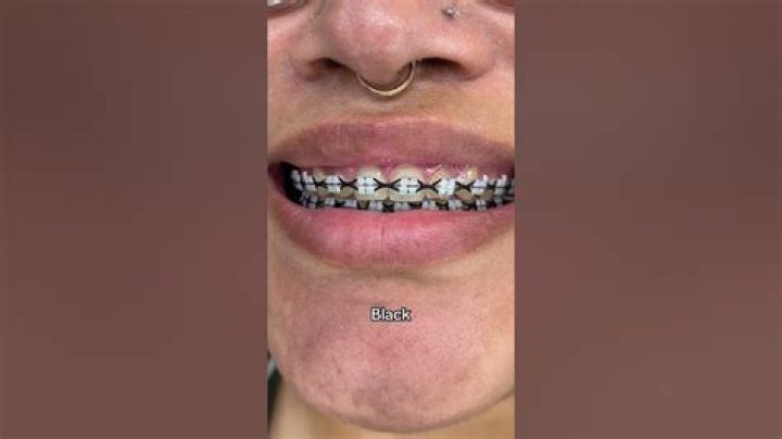 Do black braces look good?