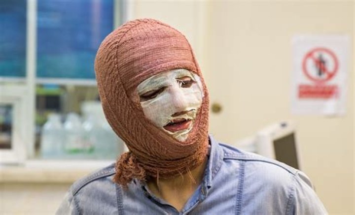 Do burn victims feel pain?