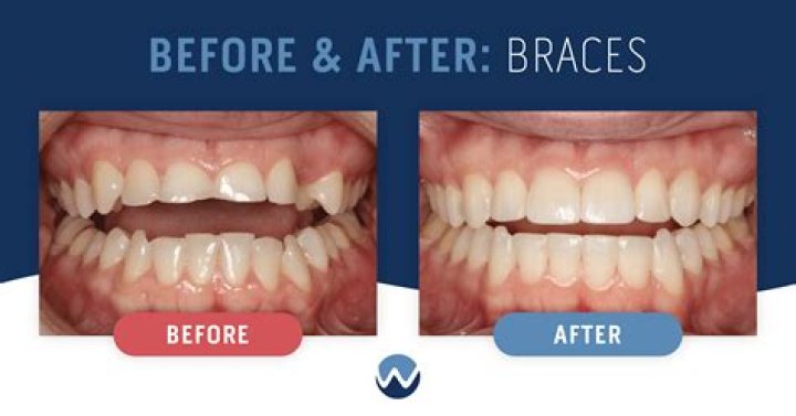 Do dentists shave teeth after braces?