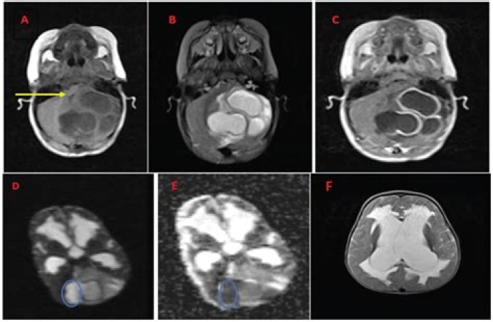 Do dermoid cysts run in families?