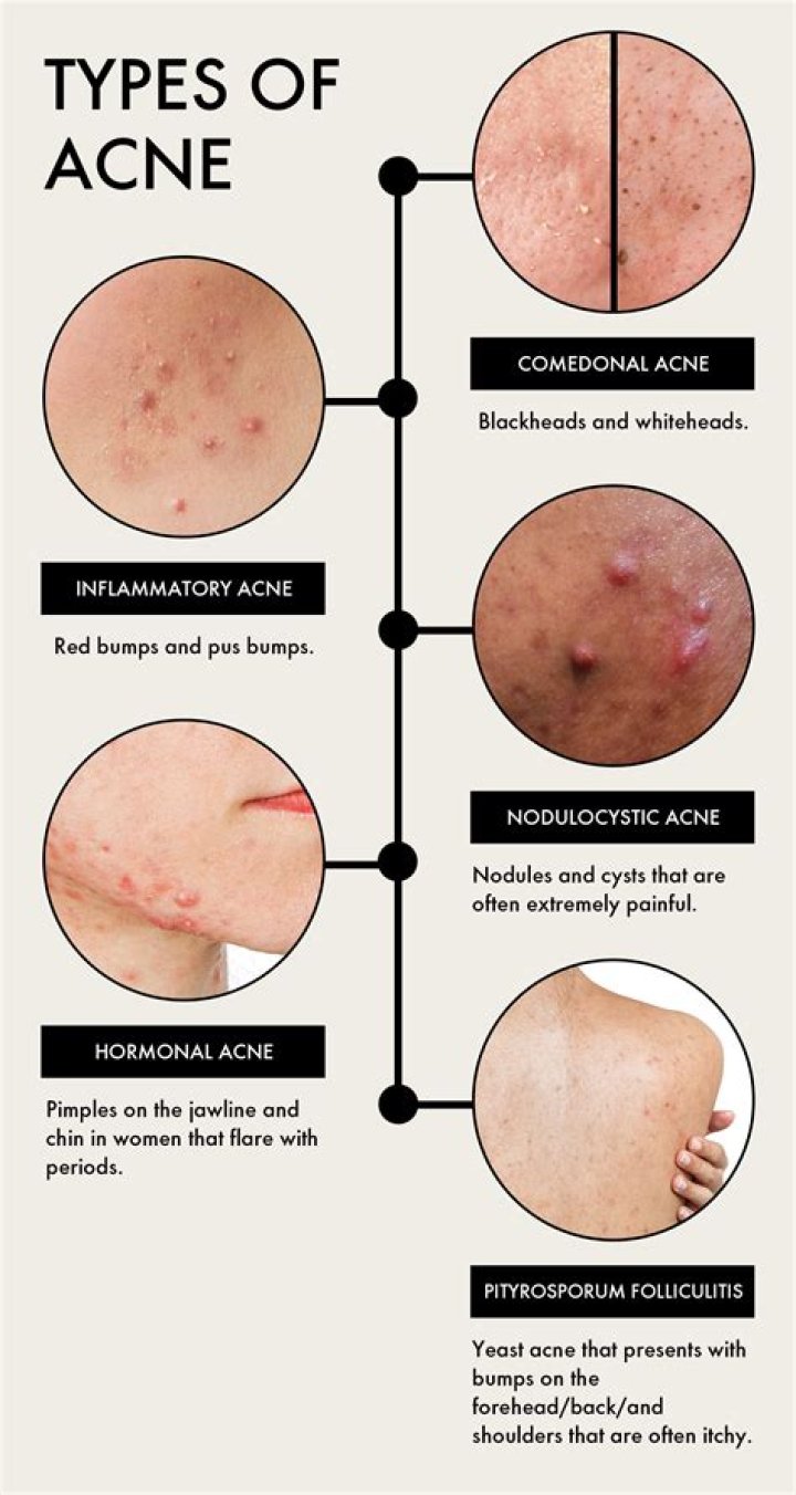 Do dirty sheets cause acne?