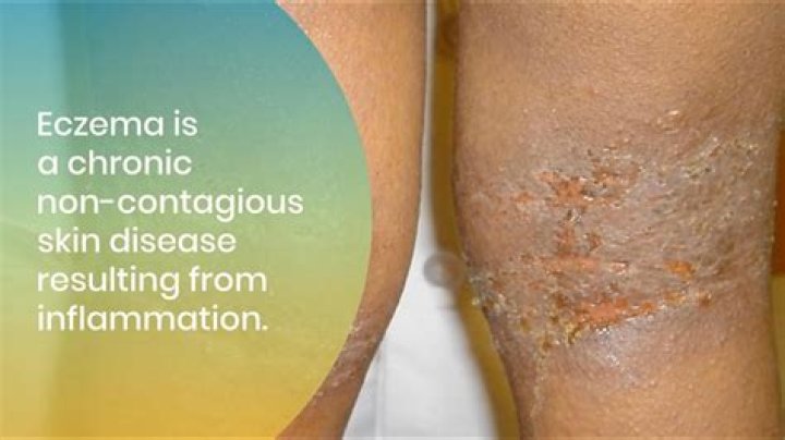 Do Ice packs help eczema?