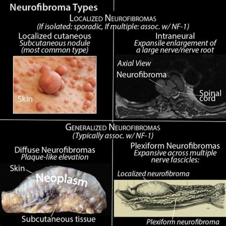 Do neurofibromas enhance?