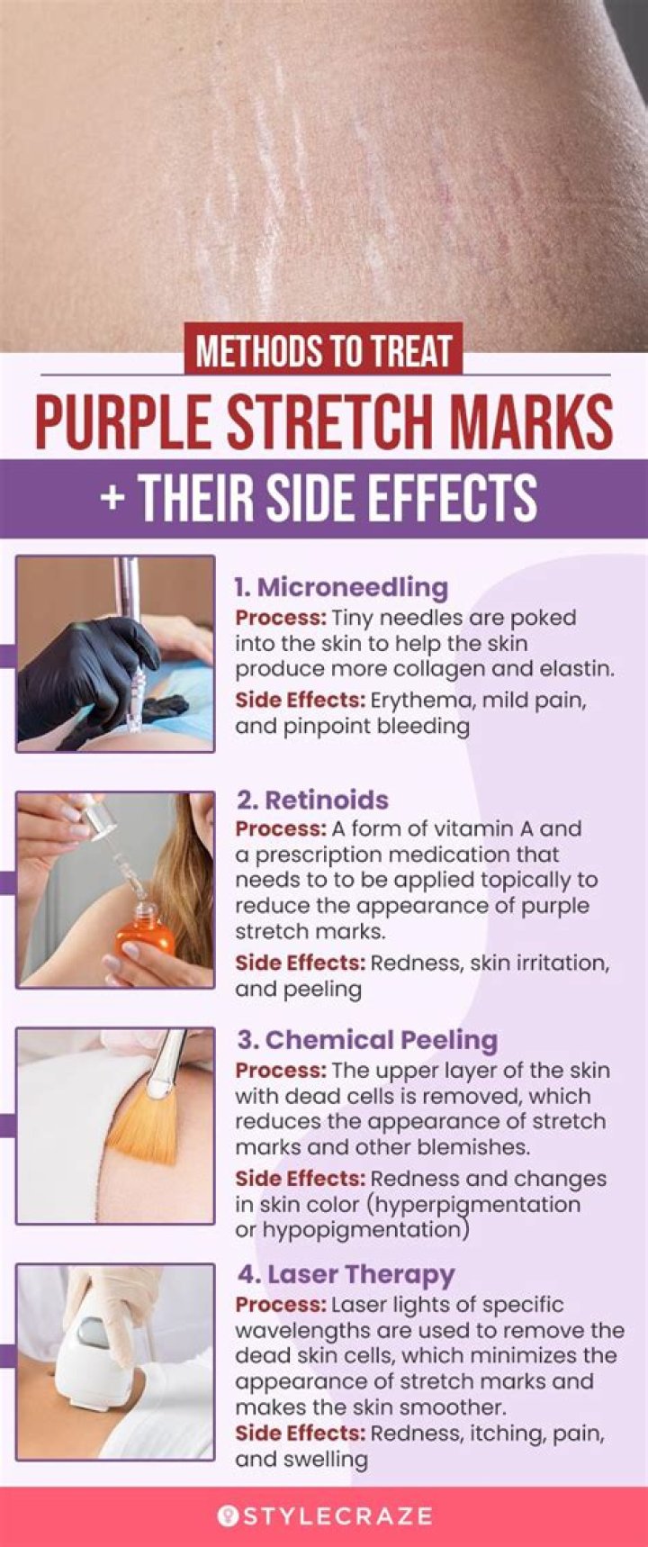 Do purple stretch marks go away?