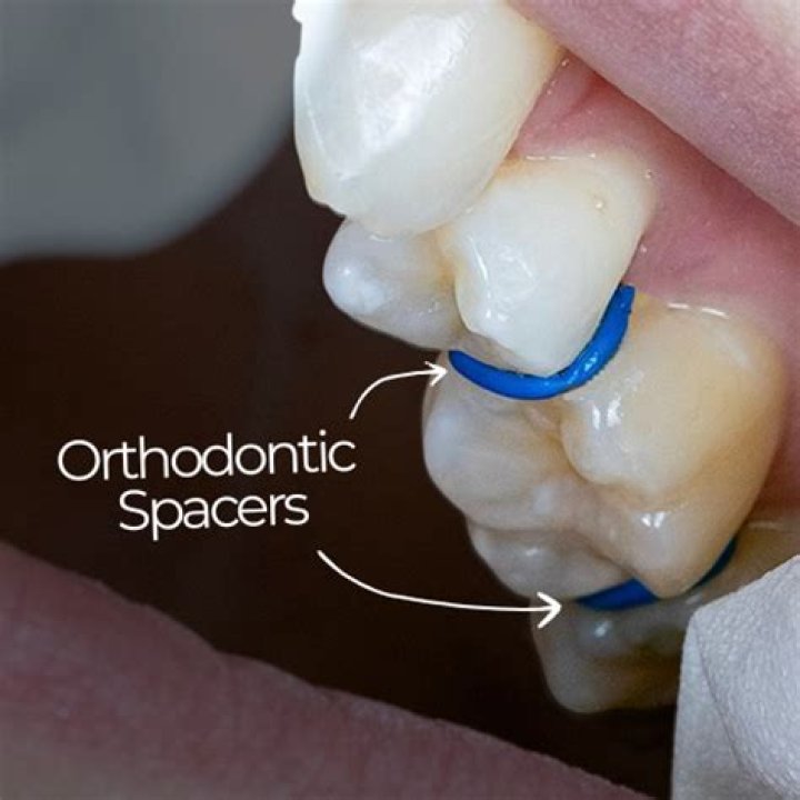Do spacers hurt the next day?