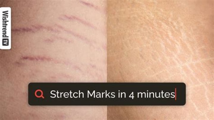 Do squats get rid of stretch marks?