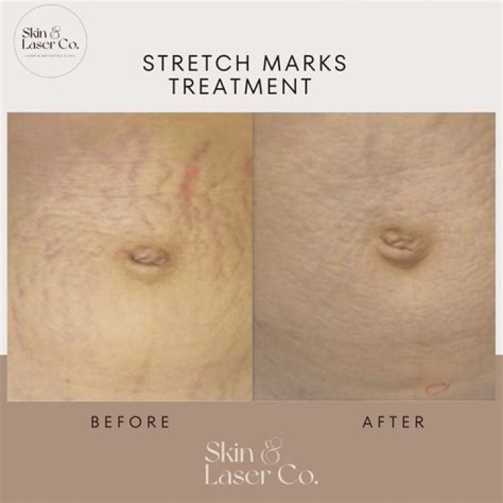 Do stretch marks eventually turn white?