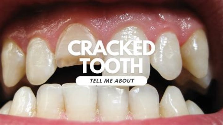 Do teeth crack age?