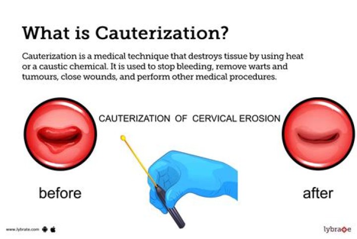 Do they cauterize tonsils?