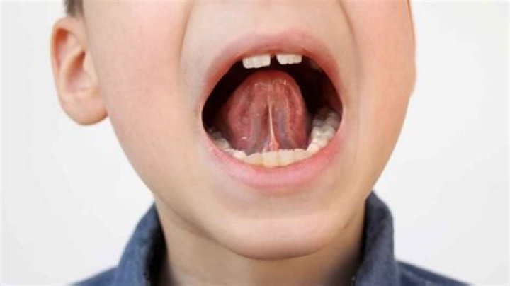 Do tongue-ties affect speech?