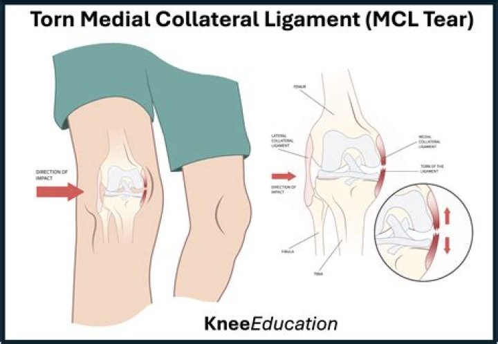 Do torn ligaments need surgery?