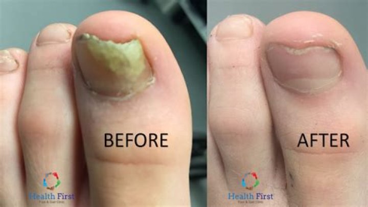 Do you have to throw away shoes if you have toenail fungus?