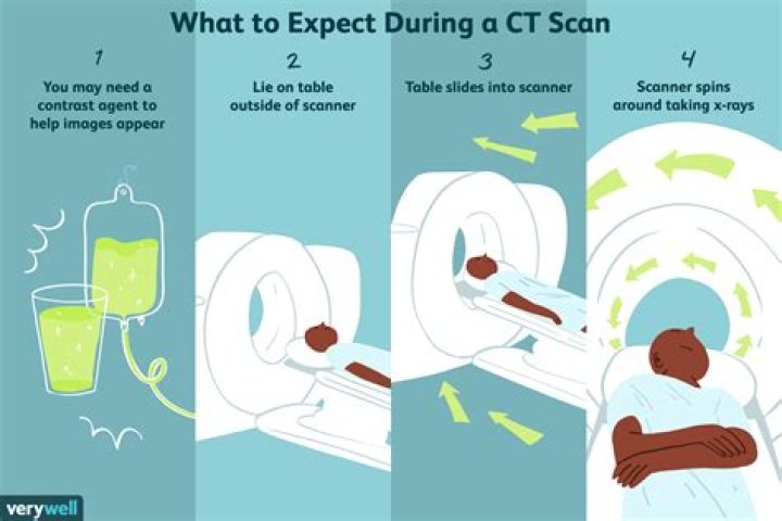 Do you need a CT scan after a seizure?