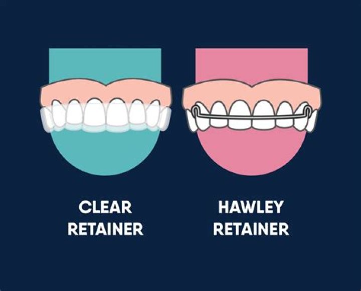 Do you need retainers forever after braces?