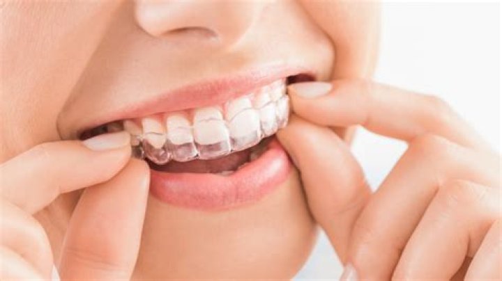 Do you throw away your old Invisalign trays?