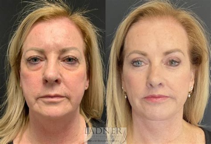 Does a facelift include eyelids?