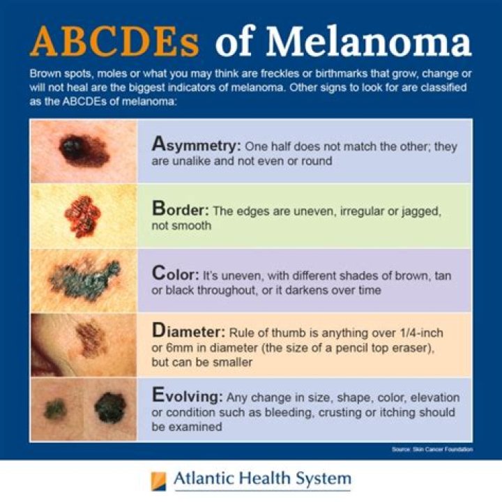 Does a melanoma itch?