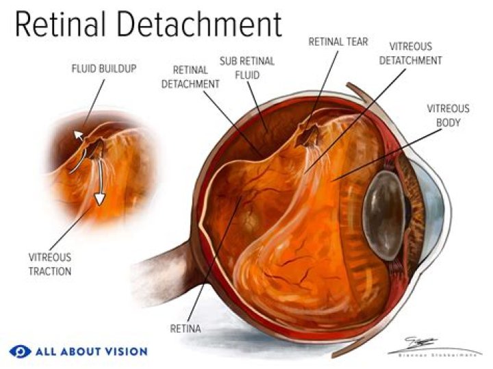 Does a retinal exam hurt?