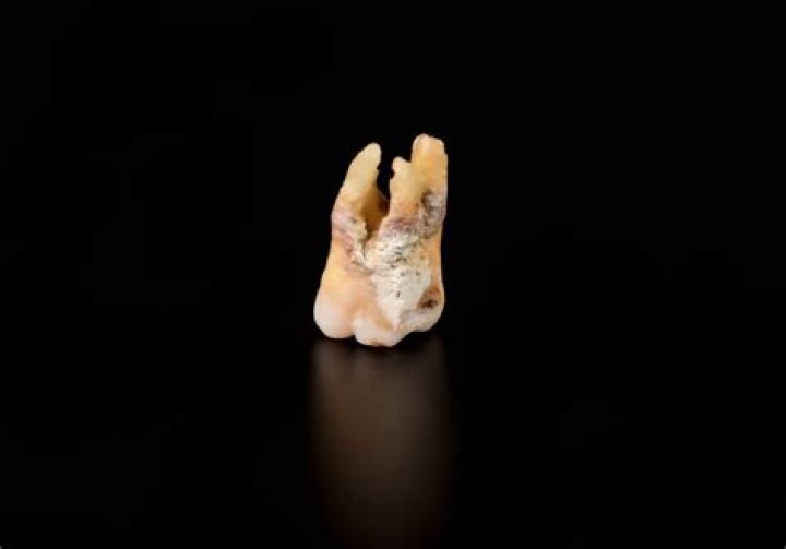Does a rotten tooth smell?