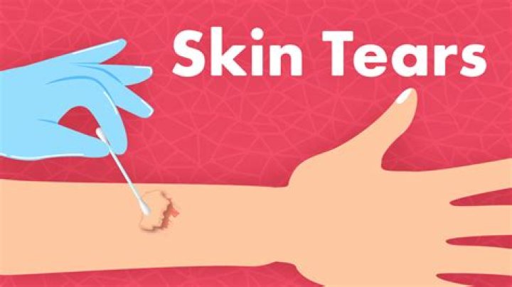 Does a skin tear need stitches?