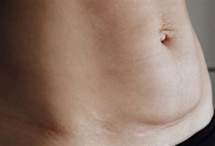 Does C-section bulge go away?