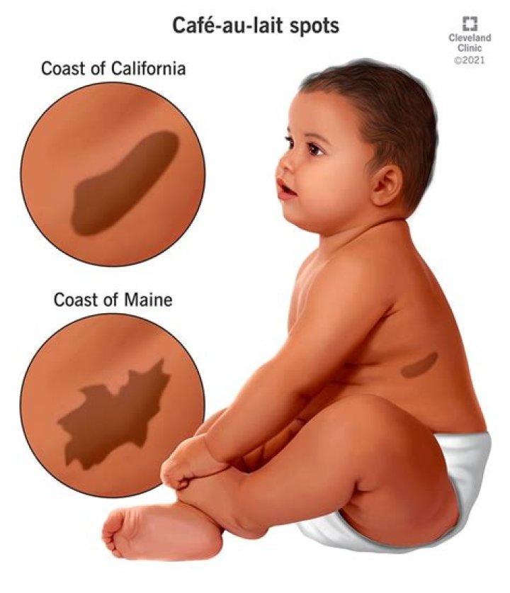 Does café-au-lait spots mean neurofibromatosis?