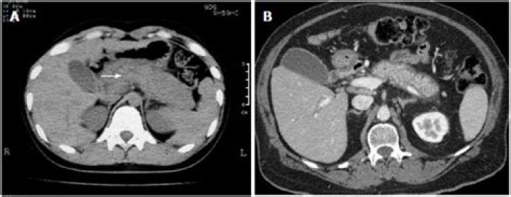 Does CT scan show autoimmune pancreatitis?