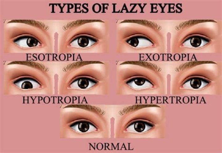 Does everyone have a lazy eye?