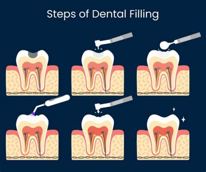 Does getting a cavity filled hurt?