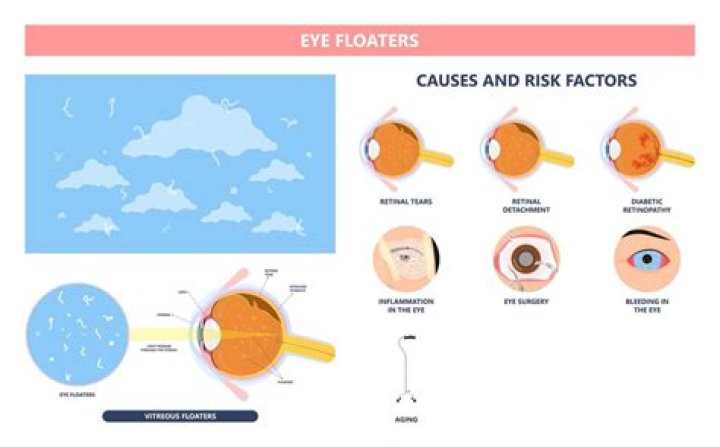Does high blood pressure cause eye floaters?