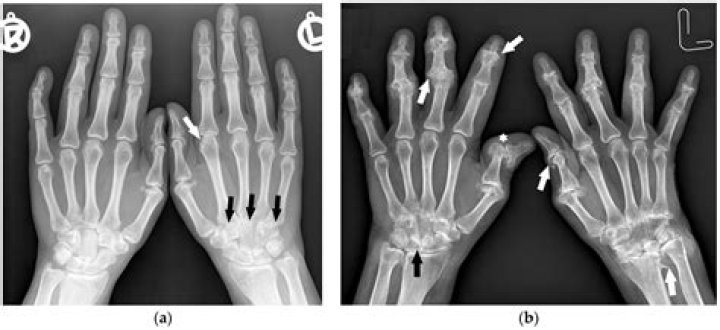Does hip arthritis show up on xray?