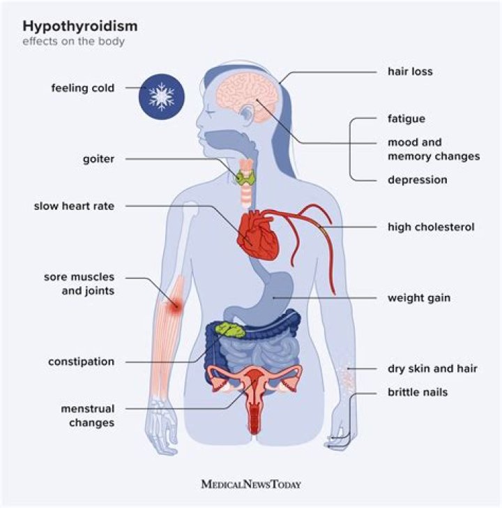 Does hypothyroidism cause early death?