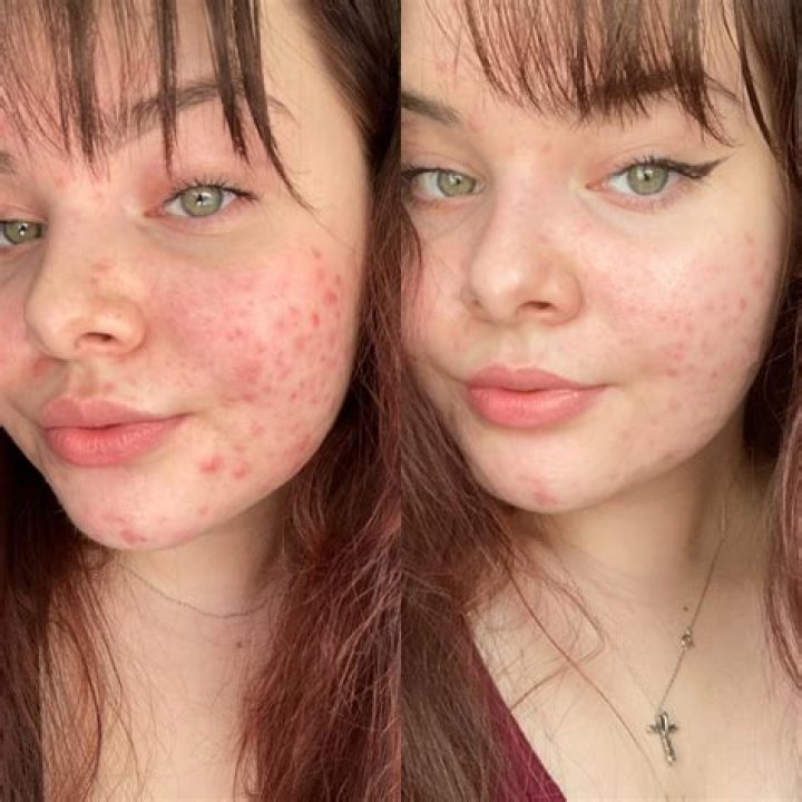 Does ice on face help acne?